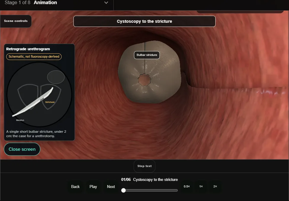 Optical urethrotomy (DVIU). Step 1: Cystoscopy to the stricture. Captured frame from the interactive animation.