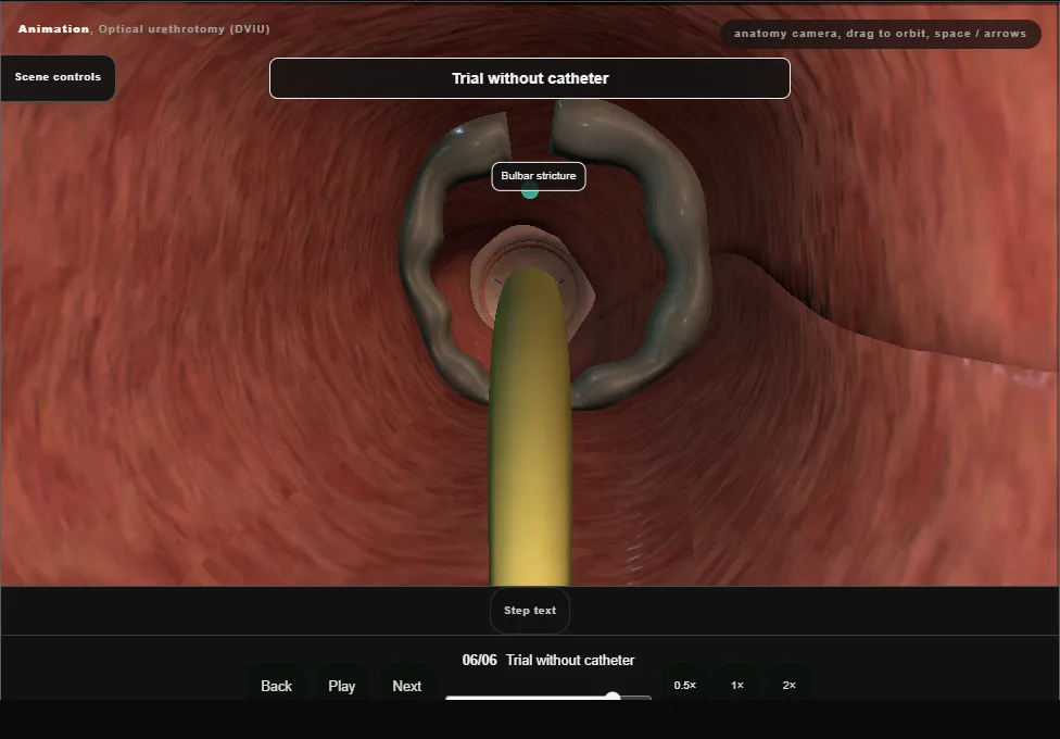 Optical urethrotomy (DVIU). Step 6: Trial without catheter. Captured frame from the interactive animation.