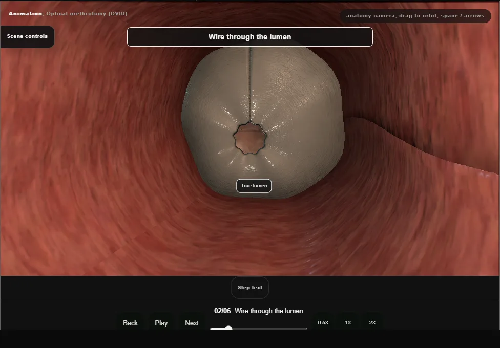 Optical urethrotomy (DVIU). Step 2: Wire through the lumen. Captured frame from the interactive animation.