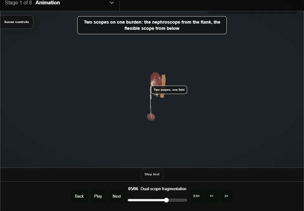 ECIRS (Galdakao-modified supine). Step 5: Dual-scope fragmentation. Captured frame from the interactive animation.