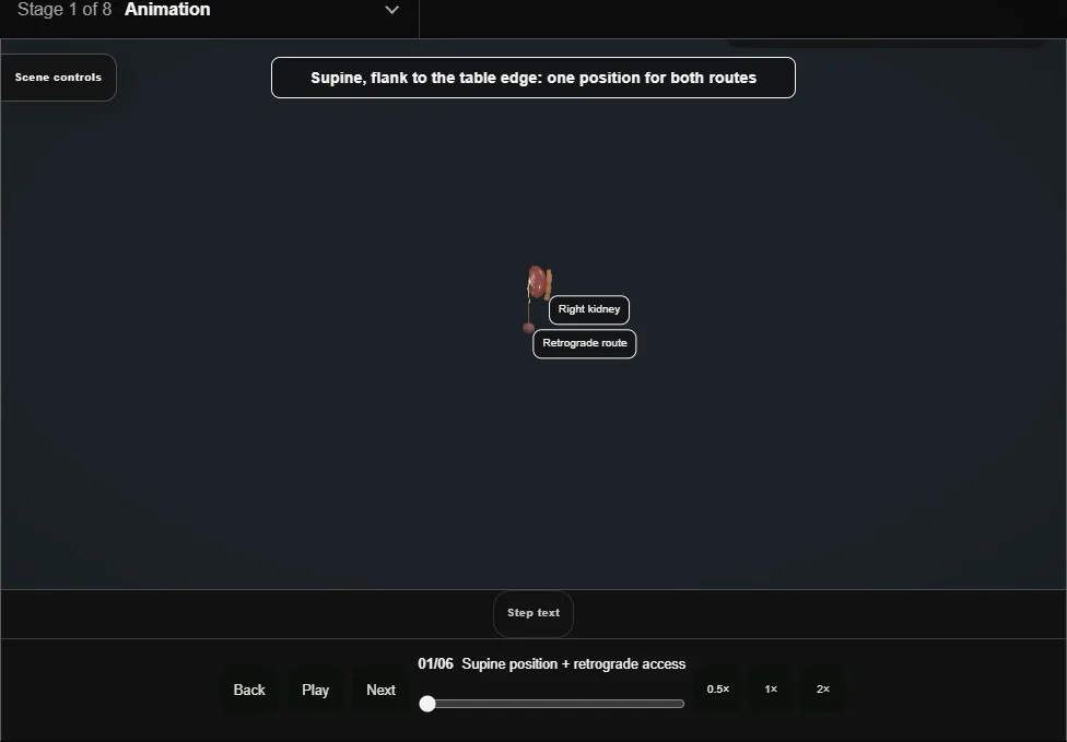 ECIRS (Galdakao-modified supine). Step 1: Supine position + retrograde access. Captured frame from the interactive animation.