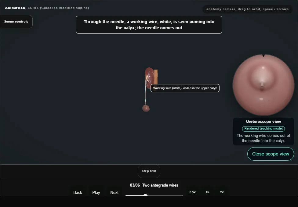 ECIRS (Galdakao-modified supine). Step 3: Two antegrade wires. Captured frame from the interactive animation.