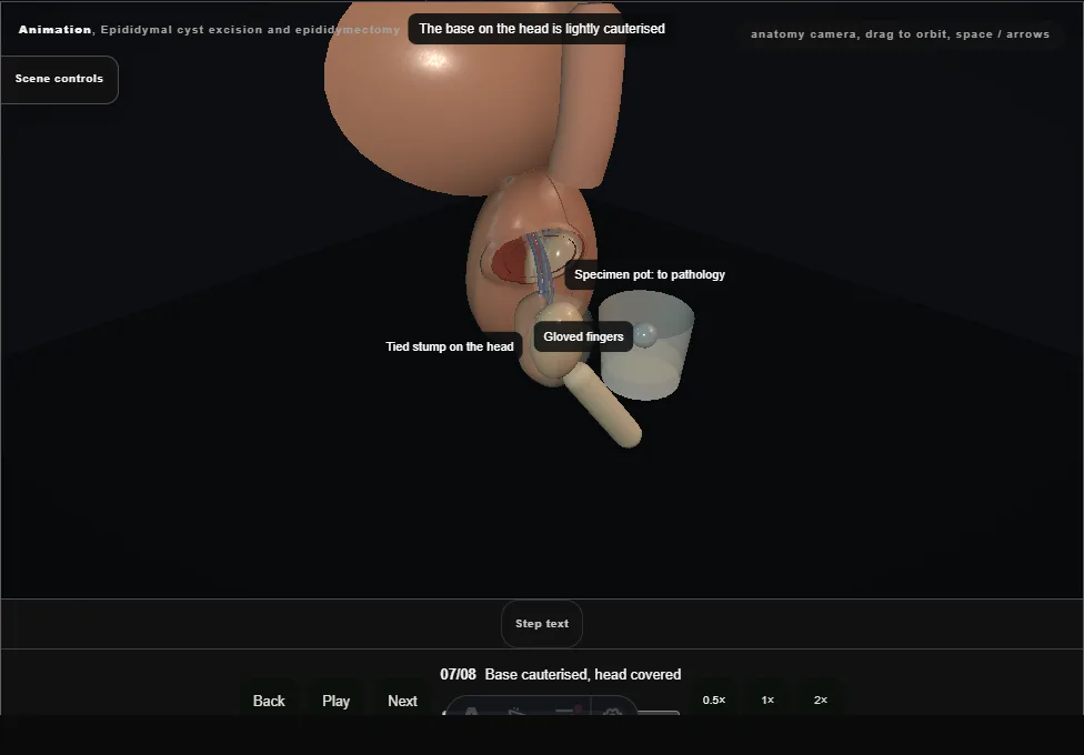 Epididymal cyst excision and epididymectomy. Step 7: Base cauterised, head covered. Captured frame from the interactive animation.