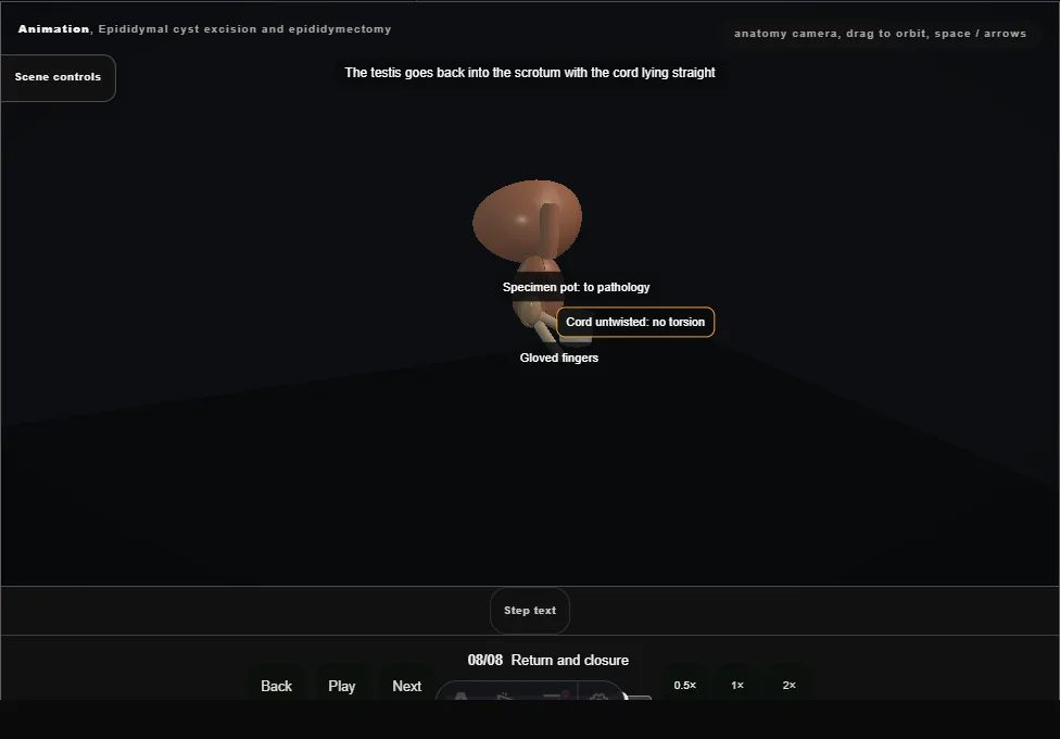 Epididymal cyst excision and epididymectomy. Step 8: Return and closure. Captured frame from the interactive animation.