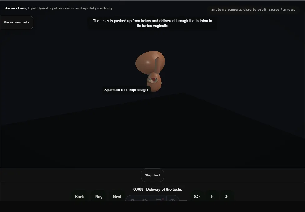 Epididymal cyst excision and epididymectomy. Step 3: Delivery of the testis. Captured frame from the interactive animation.