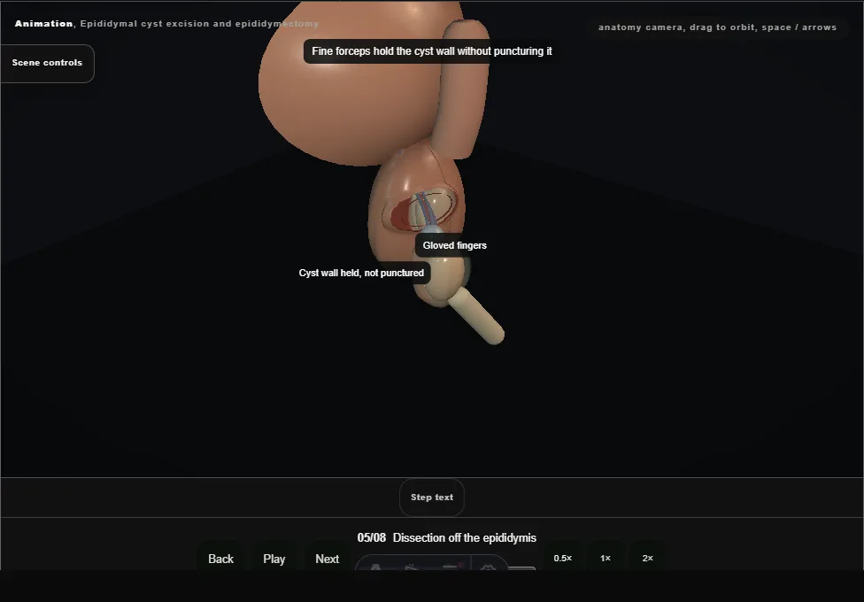 Epididymal cyst excision and epididymectomy. Step 5: Dissection off the epididymis. Captured frame from the interactive animation.
