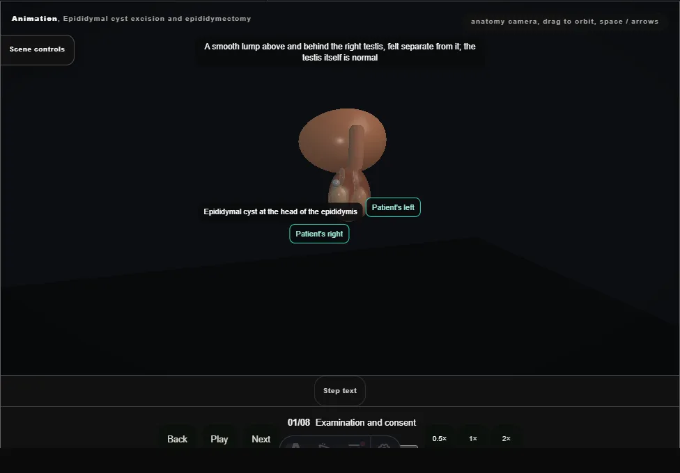 Epididymal cyst excision and epididymectomy. Step 1: Examination and consent. Captured frame from the interactive animation.