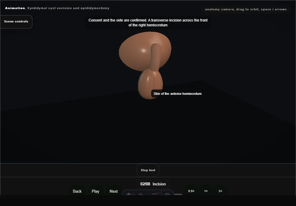 Epididymal cyst excision and epididymectomy. Step 2: Incision. Captured frame from the interactive animation.