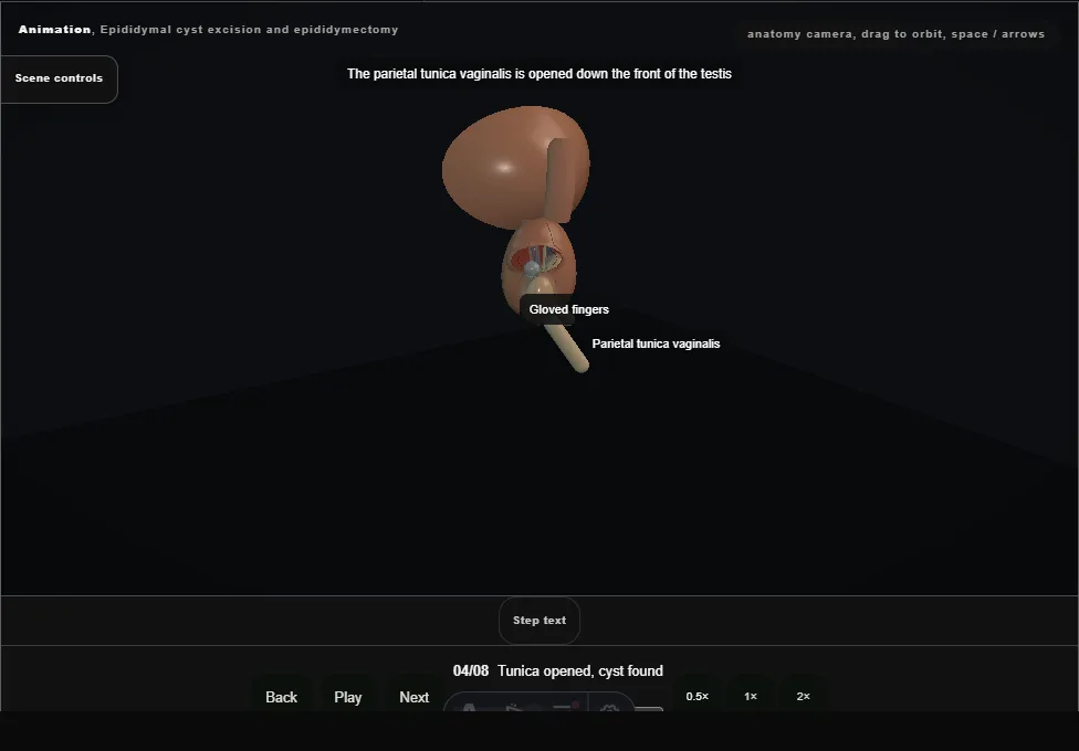 Epididymal cyst excision and epididymectomy. Step 4: Tunica opened, cyst found. Captured frame from the interactive animation.