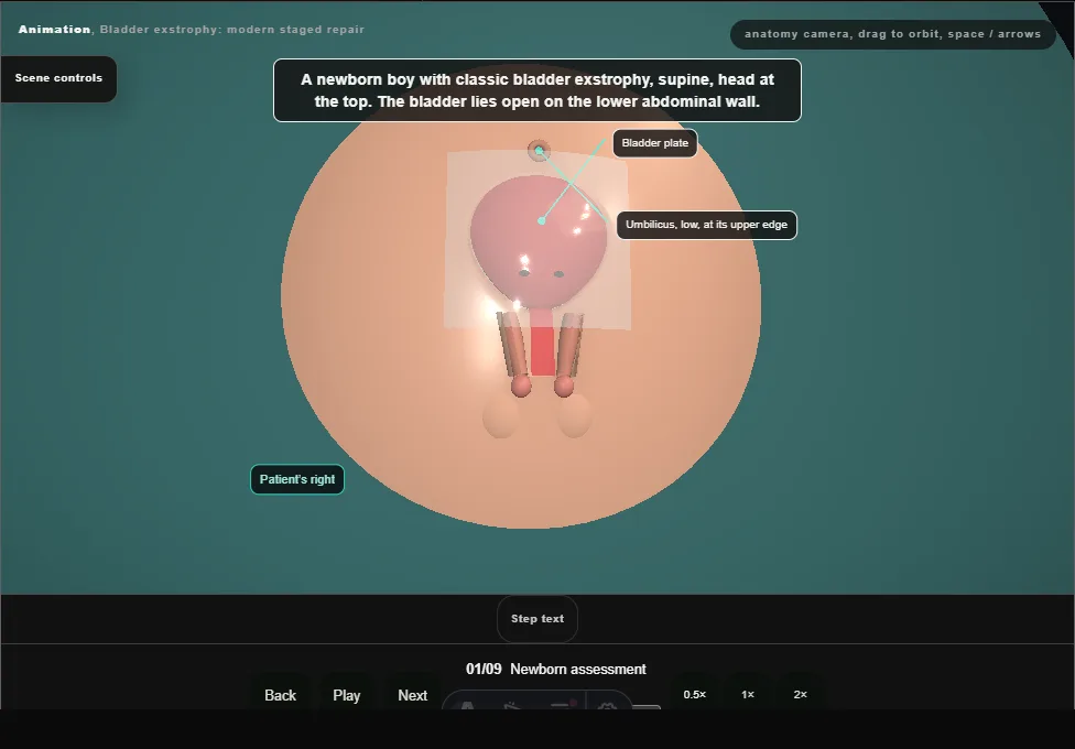 Bladder exstrophy: modern staged repair. Step 1: Newborn assessment. Captured frame from the interactive animation.
