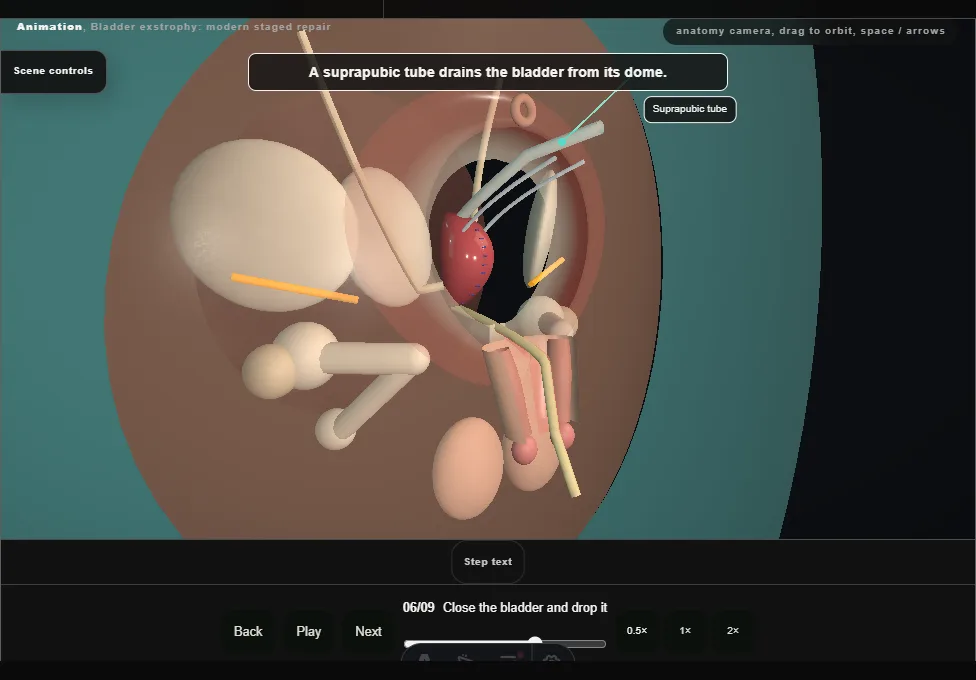 Bladder exstrophy: modern staged repair. Step 6: Close the bladder and drop it. Captured frame from the interactive animation.