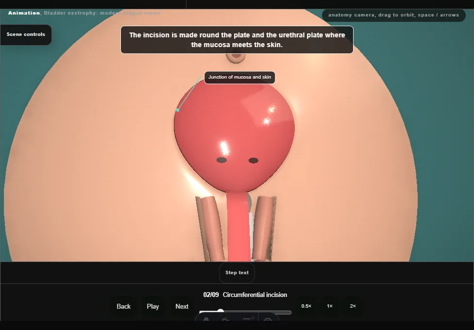 Bladder exstrophy: modern staged repair. Step 2: Circumferential incision. Captured frame from the interactive animation.