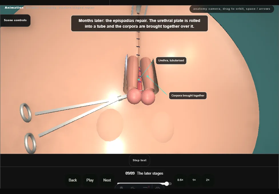 Bladder exstrophy: modern staged repair. Step 9: The later stages. Captured frame from the interactive animation.