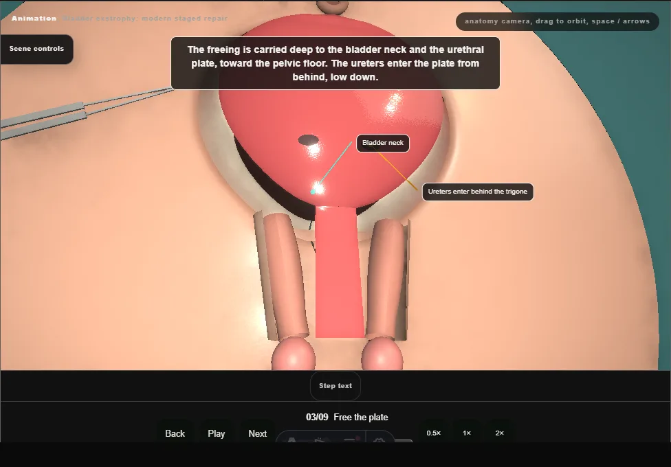 Bladder exstrophy: modern staged repair. Step 3: Free the plate. Captured frame from the interactive animation.
