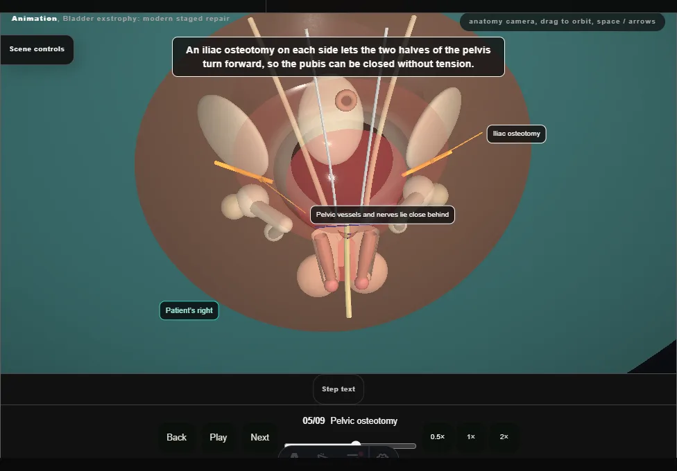 Bladder exstrophy: modern staged repair. Step 5: Pelvic osteotomy. Captured frame from the interactive animation.