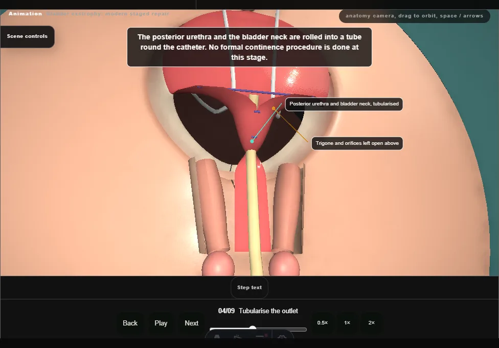 Bladder exstrophy: modern staged repair. Step 4: Tubularise the outlet. Captured frame from the interactive animation.