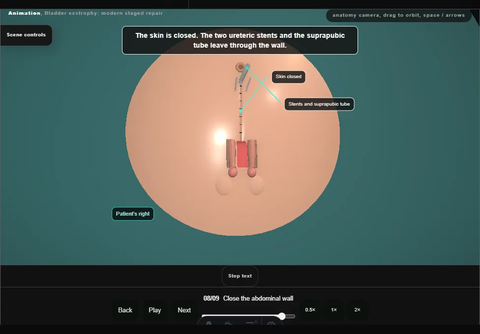 Bladder exstrophy: modern staged repair. Step 8: Close the abdominal wall. Captured frame from the interactive animation.