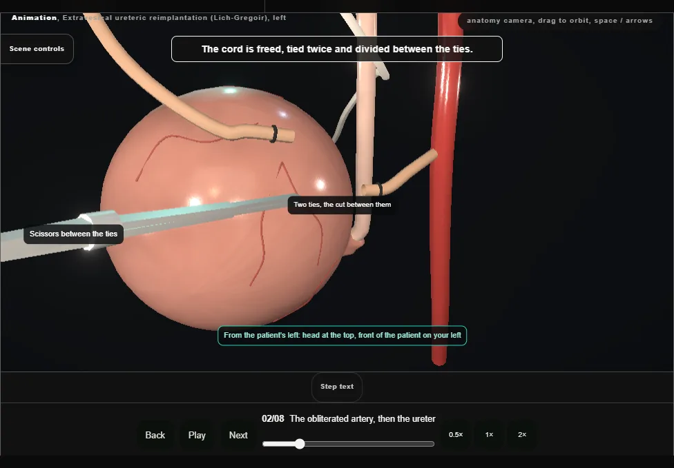 Extravesical ureteric reimplantation (Lich-Gregoir), left. Step 2: The obliterated artery, then the ureter. Captured frame from the interactive animation.
