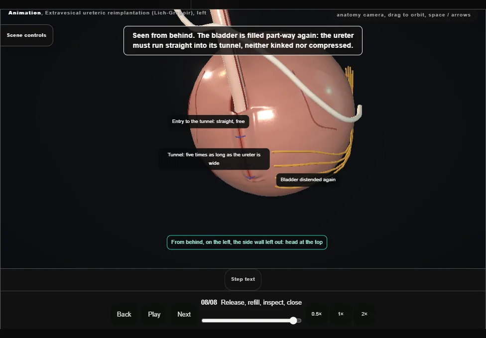 Extravesical ureteric reimplantation (Lich-Gregoir), left. Step 8: Release, refill, inspect, close. Captured frame from the interactive animation.