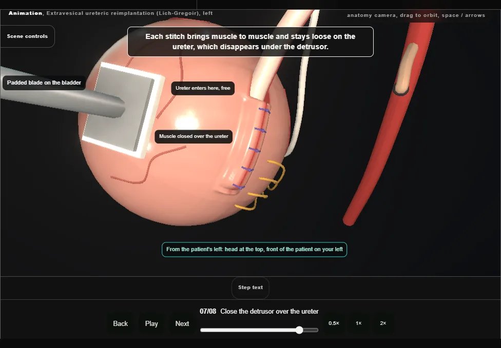 Extravesical ureteric reimplantation (Lich-Gregoir), left. Step 7: Close the detrusor over the ureter. Captured frame from the interactive animation.