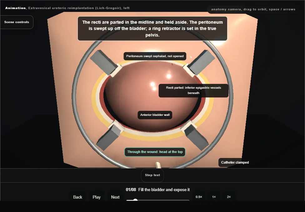 Extravesical ureteric reimplantation (Lich-Gregoir), left. Step 1: Fill the bladder and expose it. Captured frame from the interactive animation.