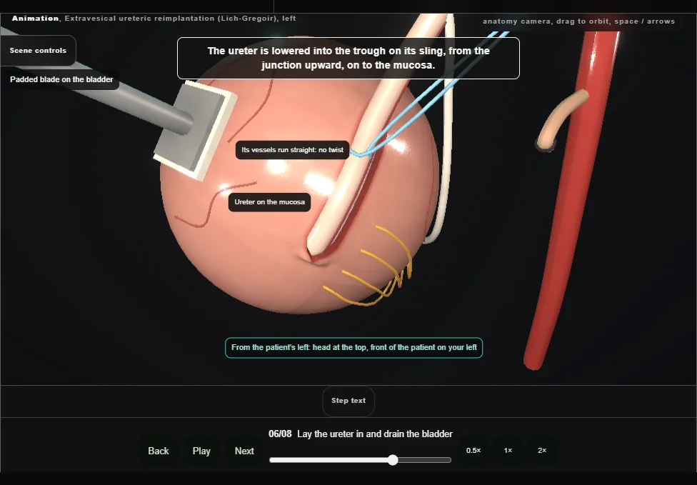 Extravesical ureteric reimplantation (Lich-Gregoir), left. Step 6: Lay the ureter in and drain the bladder. Captured frame from the interactive animation.