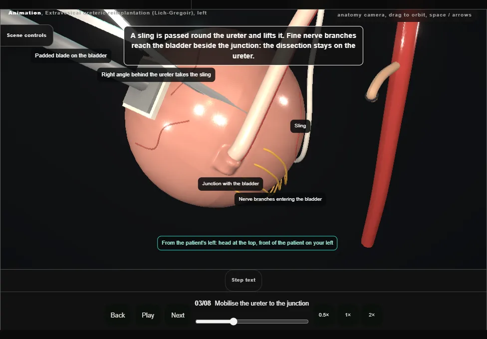 Extravesical ureteric reimplantation (Lich-Gregoir), left. Step 3: Mobilise the ureter to the junction. Captured frame from the interactive animation.