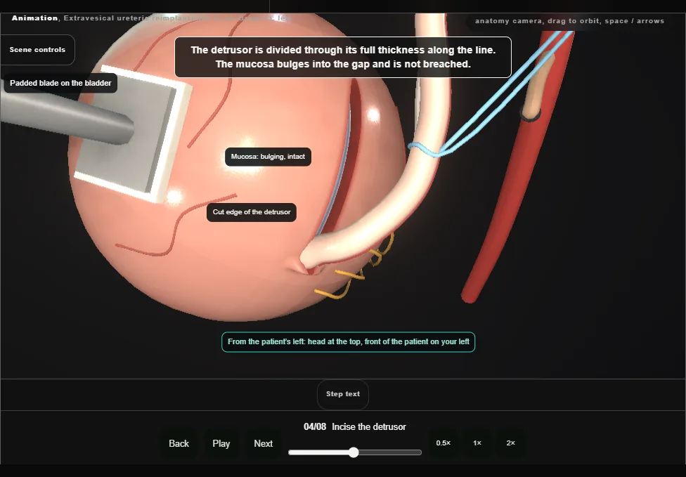 Extravesical ureteric reimplantation (Lich-Gregoir), left. Step 4: Incise the detrusor. Captured frame from the interactive animation.