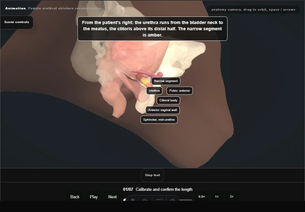 Female urethral stricture reconstruction. Step 1: Calibrate and confirm the length. Captured frame from the interactive animation.