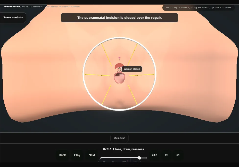 Female urethral stricture reconstruction. Step 7: Close, drain, reassess. Captured frame from the interactive animation.