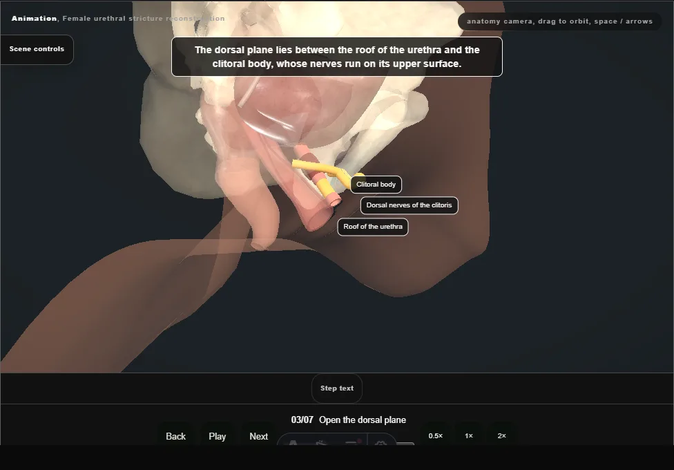 Female urethral stricture reconstruction. Step 3: Open the dorsal plane. Captured frame from the interactive animation.