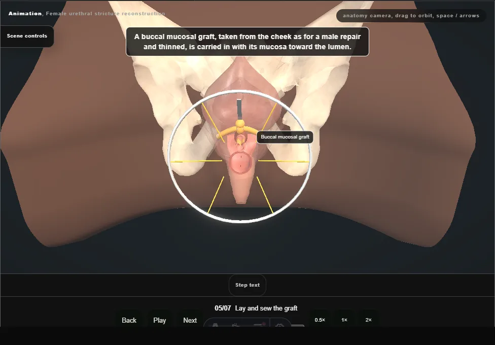 Female urethral stricture reconstruction. Step 5: Lay and sew the graft. Captured frame from the interactive animation.