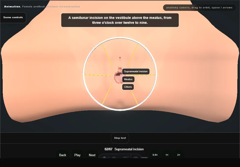 Female urethral stricture reconstruction. Step 2: Suprameatal incision. Captured frame from the interactive animation.
