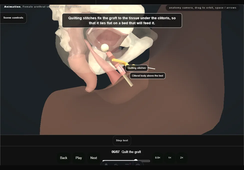 Female urethral stricture reconstruction. Step 6: Quilt the graft. Captured frame from the interactive animation.