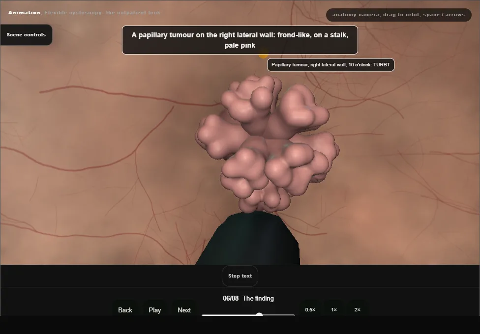 Flexible cystoscopy: the outpatient look. Step 6: The finding. Captured frame from the interactive animation.