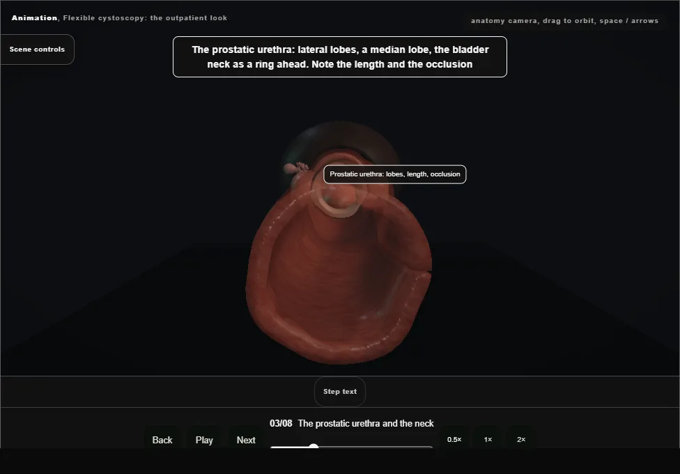 Flexible cystoscopy: the outpatient look. Step 3: The prostatic urethra and the neck. Captured frame from the interactive animation.