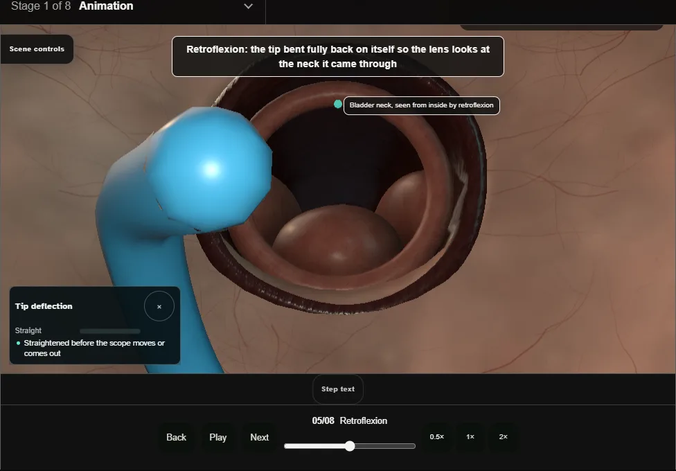 Flexible cystoscopy: the outpatient look. Step 5: Retroflexion. Captured frame from the interactive animation.