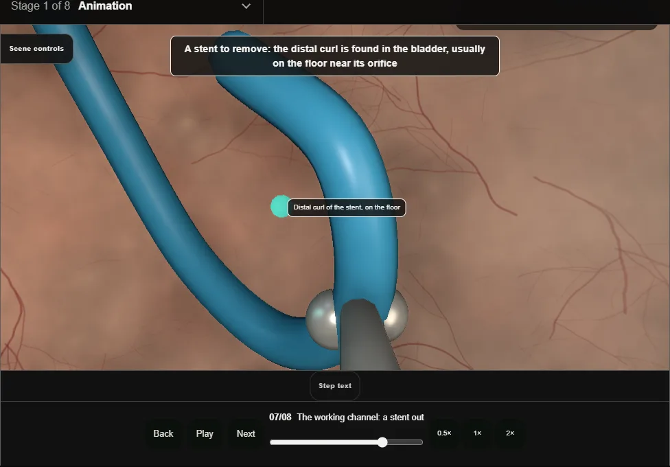 Flexible cystoscopy: the outpatient look. Step 7: The working channel: a stent out. Captured frame from the interactive animation.
