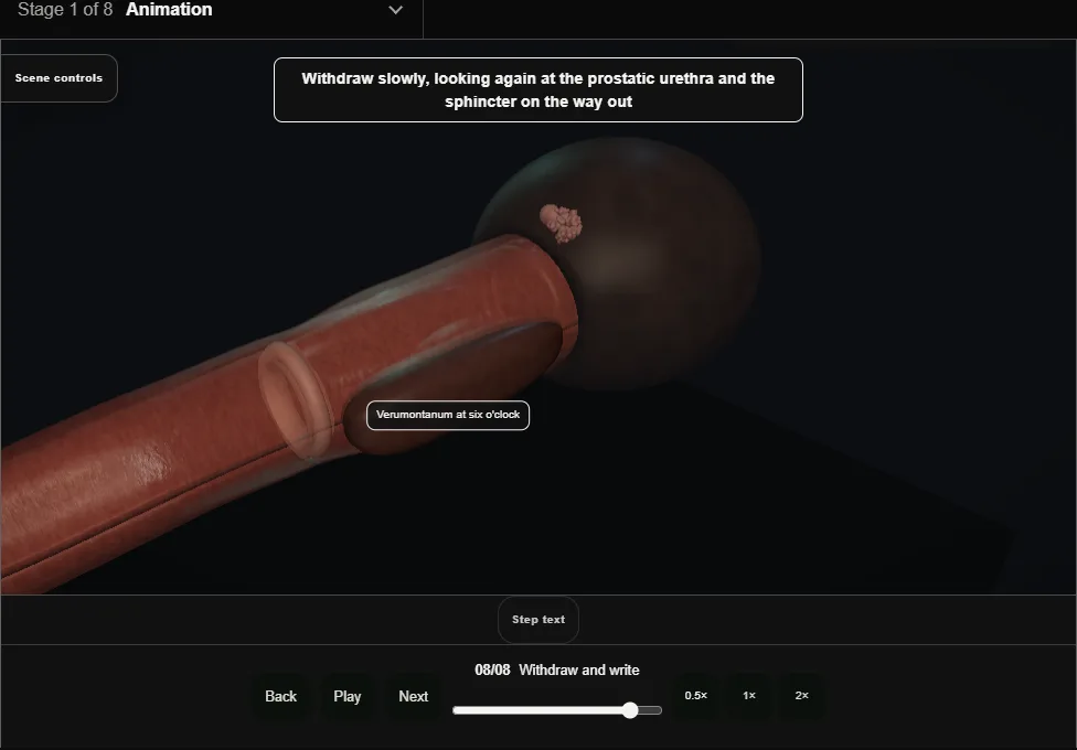 Flexible cystoscopy: the outpatient look. Step 8: Withdraw and write. Captured frame from the interactive animation.