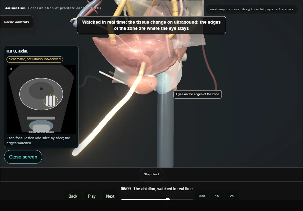 Focal ablation of prostate cancer (HIFU). Step 6: The ablation, watched in real time. Captured frame from the interactive animation.