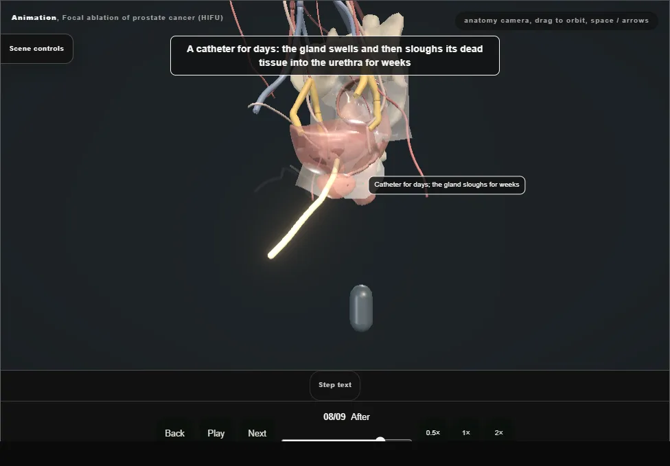 Focal ablation of prostate cancer (HIFU). Step 8: After. Captured frame from the interactive animation.