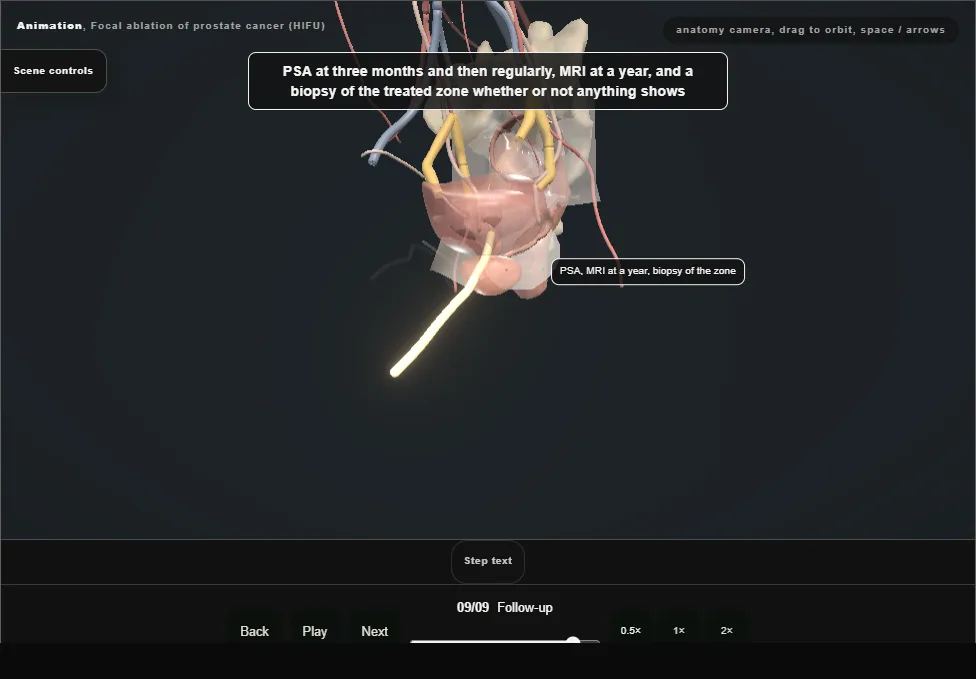Focal ablation of prostate cancer (HIFU). Step 9: Follow-up. Captured frame from the interactive animation.