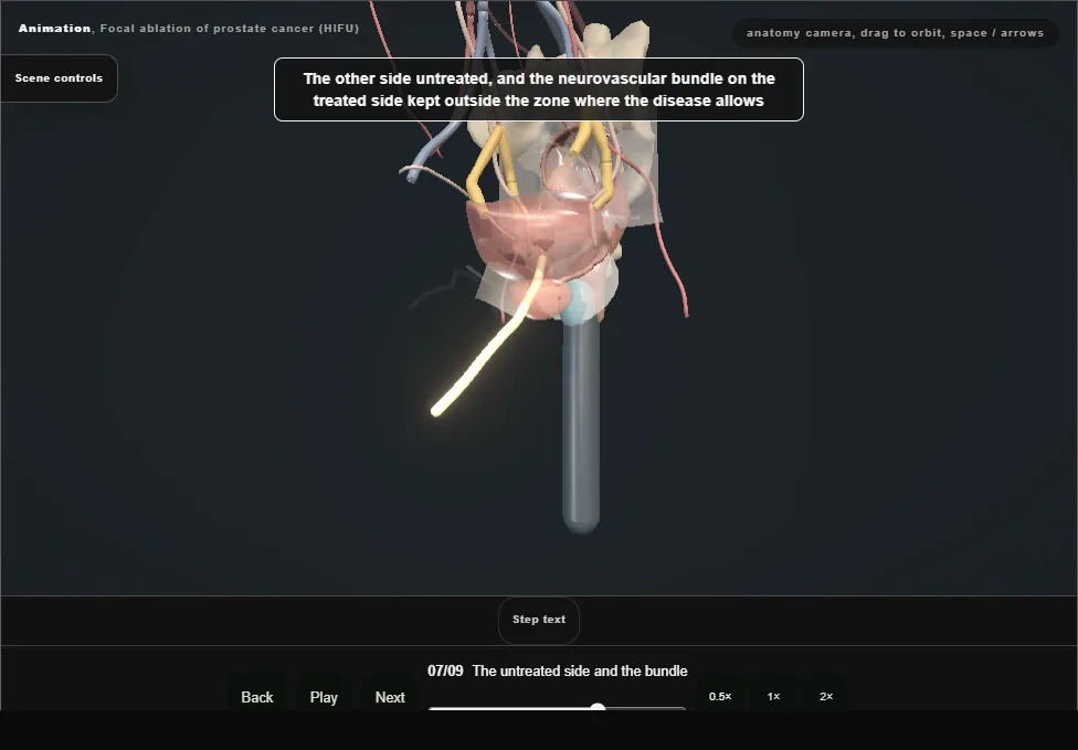 Focal ablation of prostate cancer (HIFU). Step 7: The untreated side and the bundle. Captured frame from the interactive animation.
