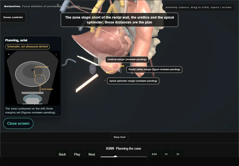 Focal ablation of prostate cancer (HIFU). Step 3: Planning the zone. Captured frame from the interactive animation.
