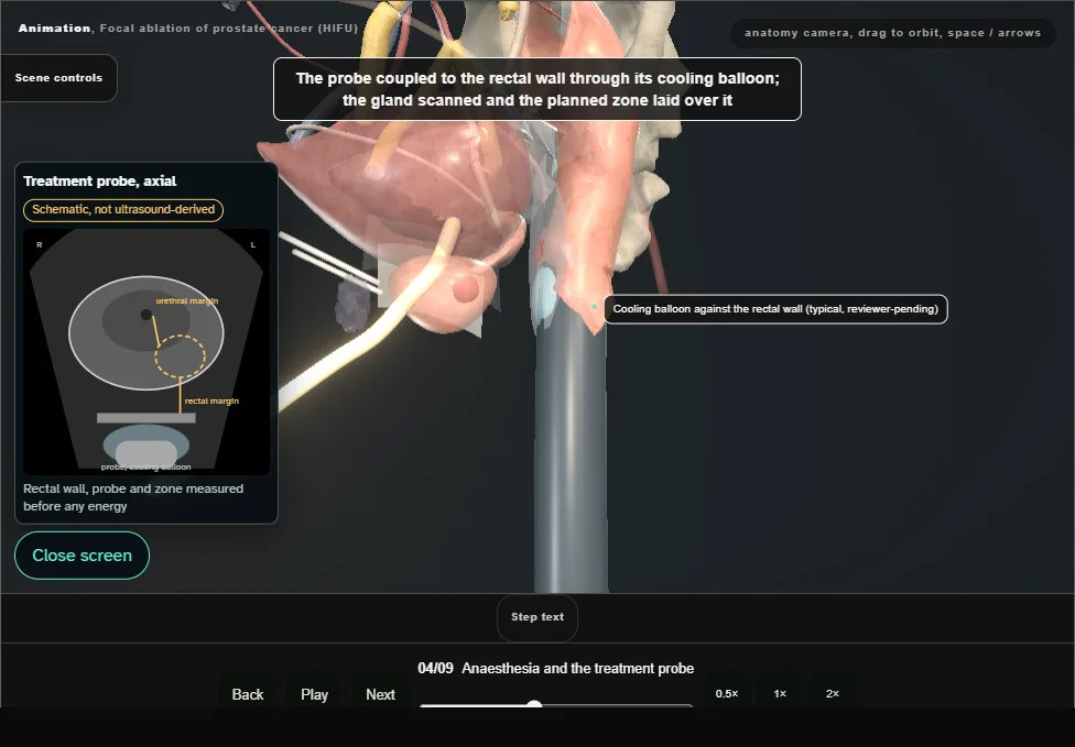 Focal ablation of prostate cancer (HIFU). Step 4: Anaesthesia and the treatment probe. Captured frame from the interactive animation.