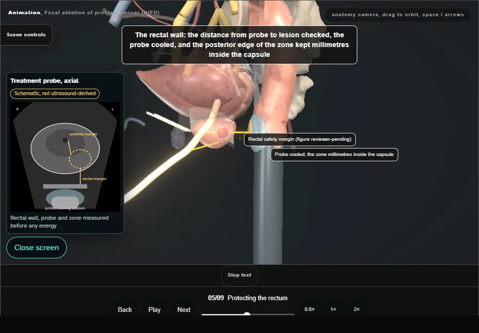Focal ablation of prostate cancer (HIFU). Step 5: Protecting the rectum. Captured frame from the interactive animation.