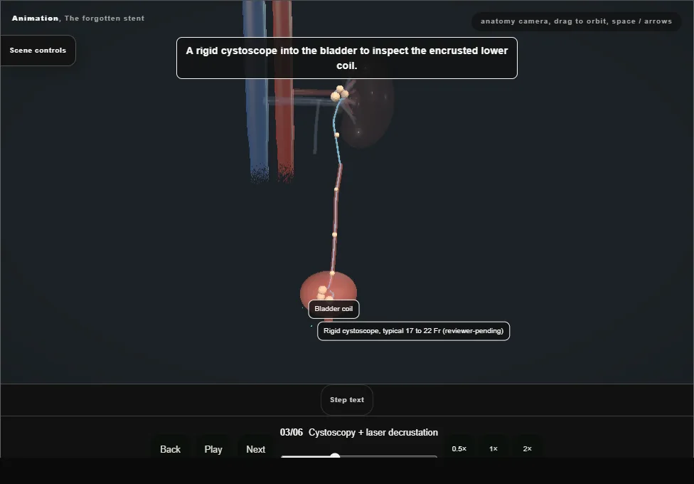 The forgotten stent. Step 3: Cystoscopy + laser decrustation. Captured frame from the interactive animation.