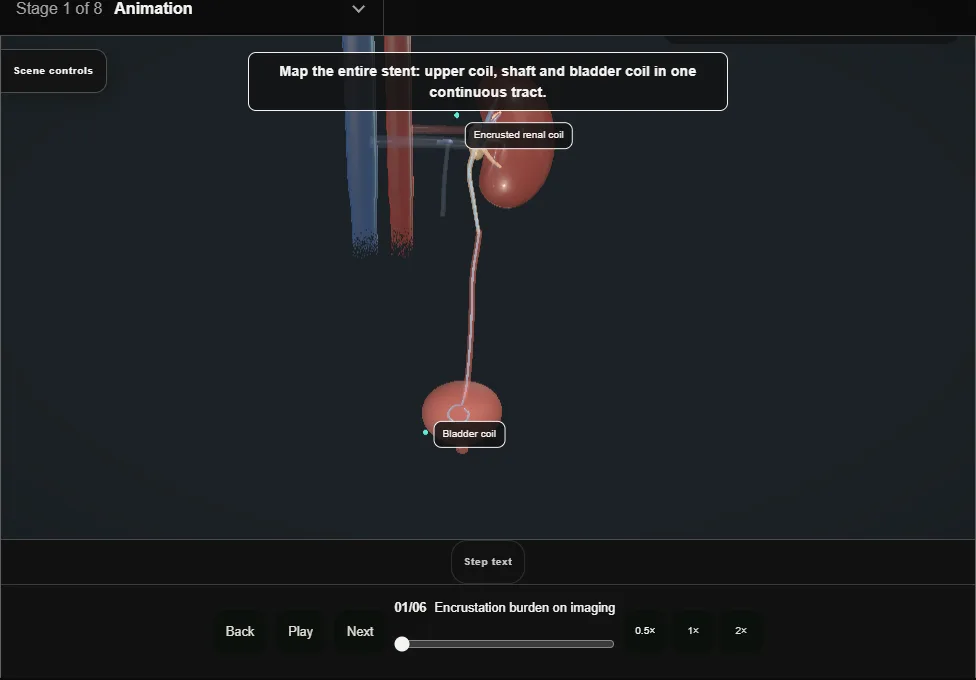 The forgotten stent. Step 1: Encrustation burden on imaging. Captured frame from the interactive animation.