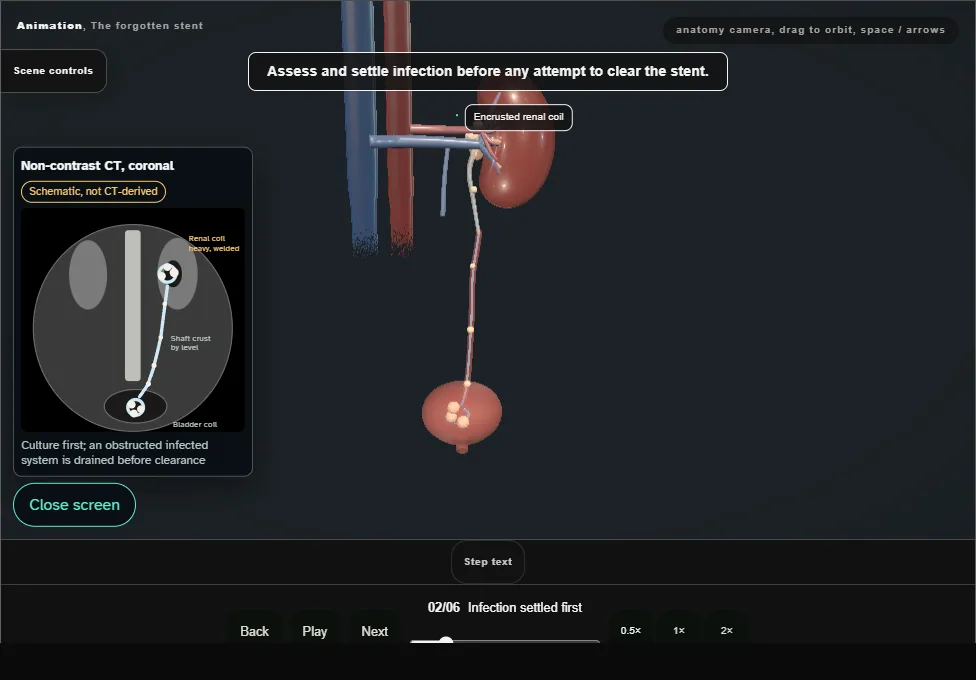 The forgotten stent. Step 2: Infection settled first. Captured frame from the interactive animation.