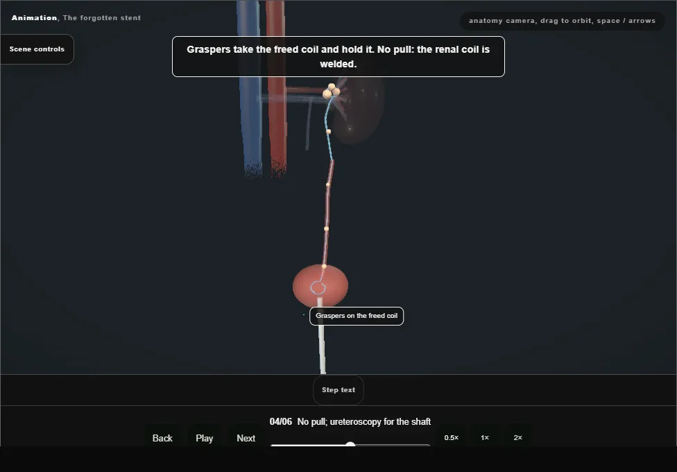 The forgotten stent. Step 4: No pull; ureteroscopy for the shaft. Captured frame from the interactive animation.